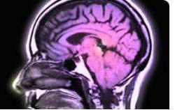 Image of a human brain scan from a CJD patient.